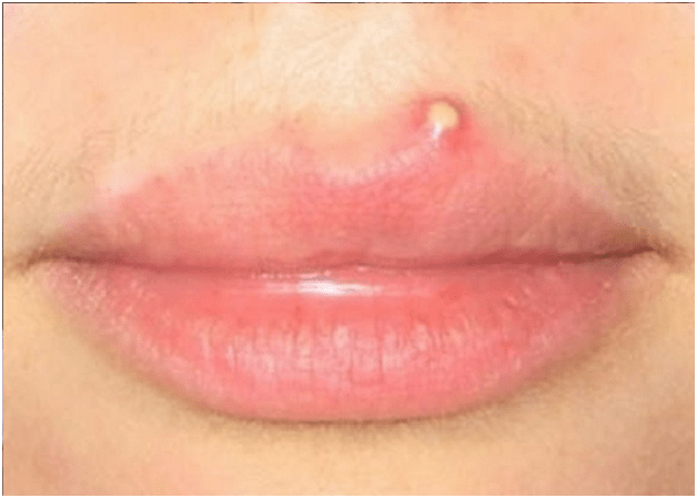 唇に白い隆起 唇のにきびとは何ですか そしてそれらを取り除く方法