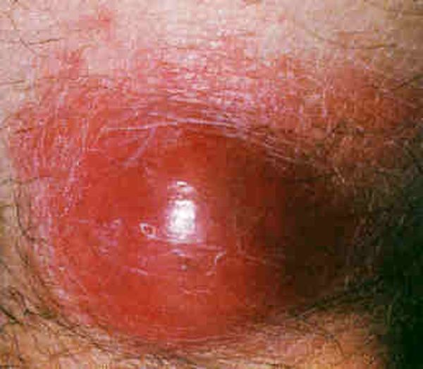 Penis eingewachsene haare am Haarwurzelentzündung: Symptome,