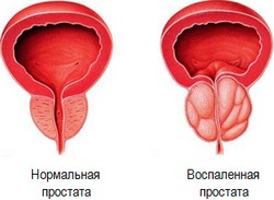 prostatitis és koka