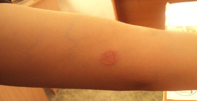 Fungo nel corpo. il fungo nel sangue la lotta contro una terribile ... Disinfettare vestiti dai funghi