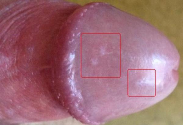 Penis pigmentstörung Pigmentstörung am