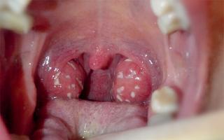 Why do the tonsils burn and how do you treat them?