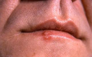 Prevention of herpes on the lips: tablets