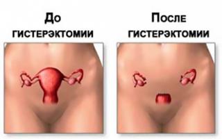 How long does it take to remove the uterus?