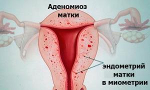 Adenomiosi dell'utero - diffusa e vuzloviana, sintomi e segni, algoritmo di trattamento, rimedi popolari Sintomi e foto dell'adenomiosi dell'utero